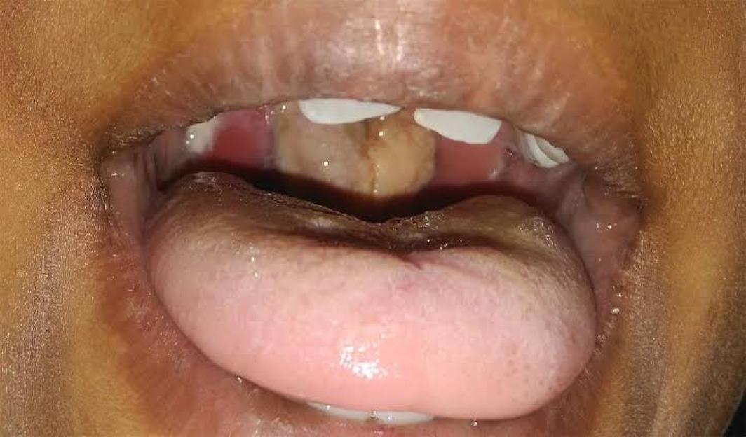 Plateau Diphtheria Crisis: Death Toll Reaches 27 with 303 Confirmed Cases