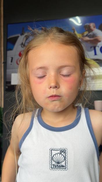 Paige-leigh Baxter's daughter Aylah showing skin irritation around her eyes and mouth.