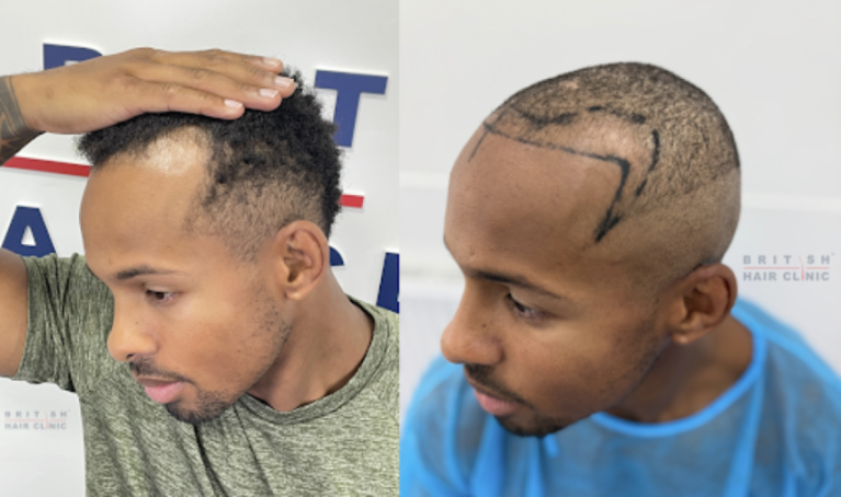 Collage of before and after images of a man undergoing a hair transplant procedure.