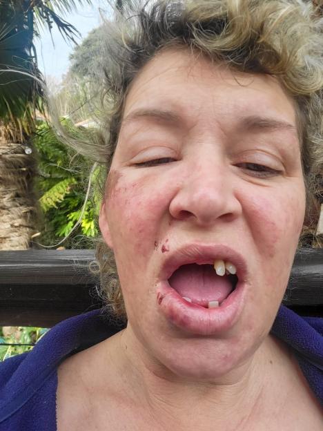SNPothole- mother whose life has been changed forever after she tripped on a deep pothole said no one has taken responsibility