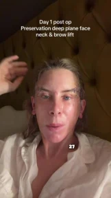 Real Housewives star reveals bloodied and stitched face after surgery and reveals she’s had no pain killers