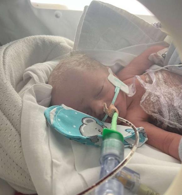 Newborn baby Luca, with gastroschisis, receiving medical care in an incubator.