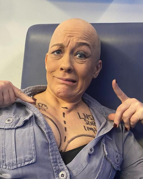 A bald woman with surgical markings on her chest and neck smiles at the camera while pointing to the markings.