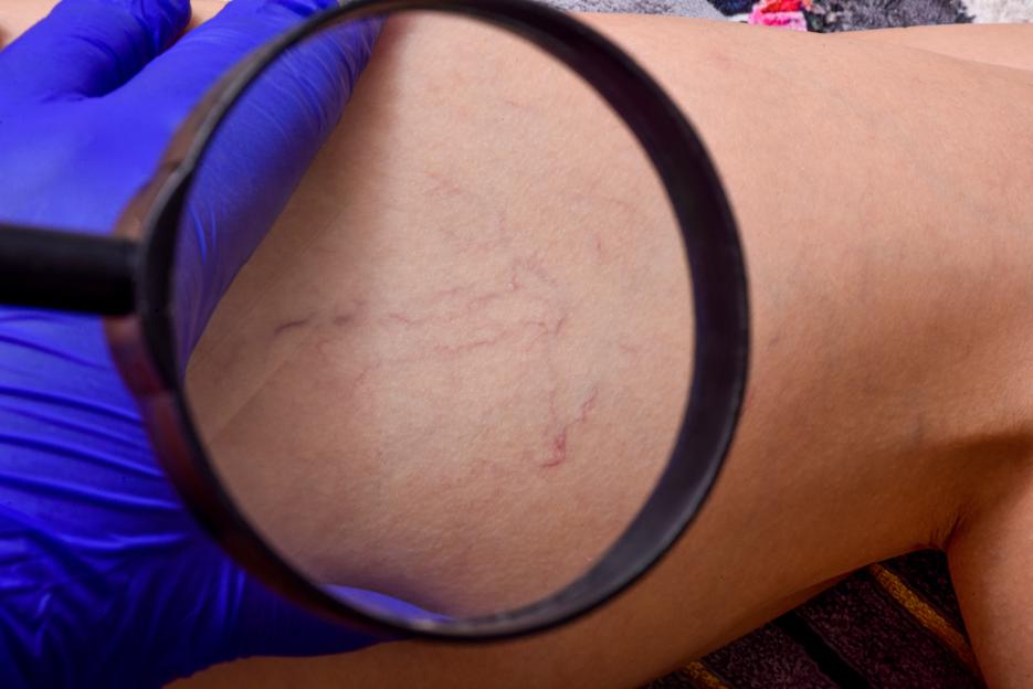 A magnifying glass held by a gloved hand inspects spider veins on a woman's legs.