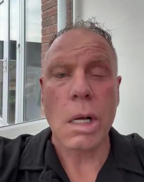 Andy Morrison with a black eye and bloodshot eye.
