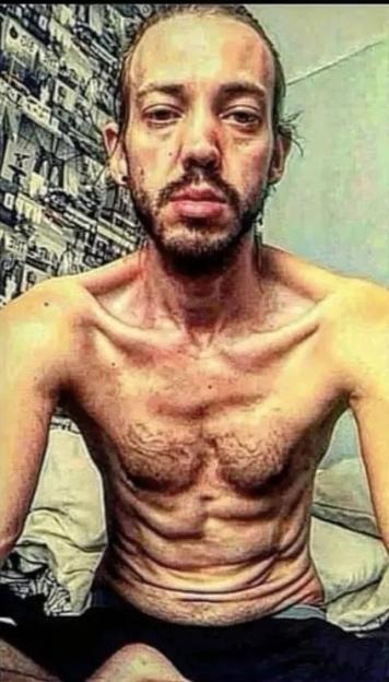 Collage of a man's physical transformation from emaciated to healthy.