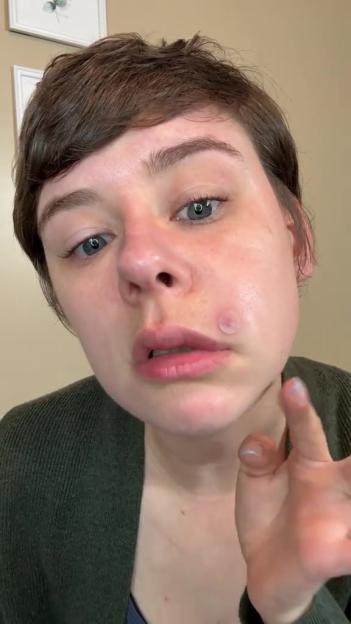 'Woman Issues Urgent Warning Against Popping Pimples in the 'Triangle of Death' After Suffering Infection and Scarring'