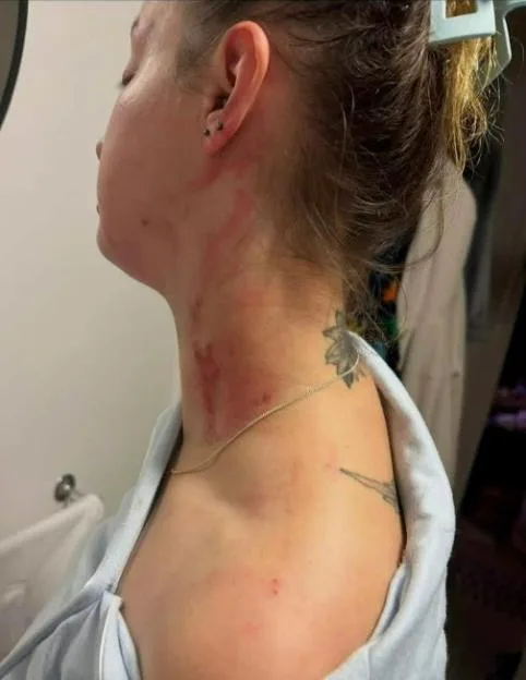 Hayleigh Allsopp's injuries.