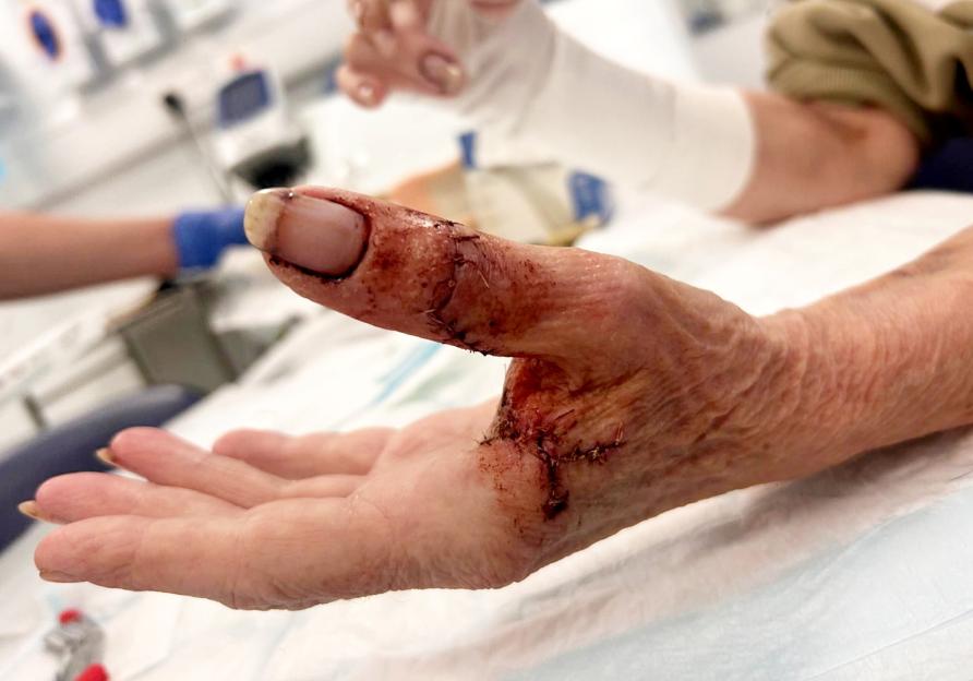 Linda Harris's hand shows extensive injuries, with deep cuts and visible stitches on her thumb and palm.