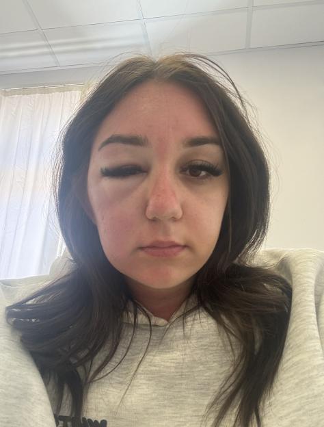 Holiday horror as Brit¿s ¿eye bags¿ lead to mystery illness ¿ trapping her in Greek hospital