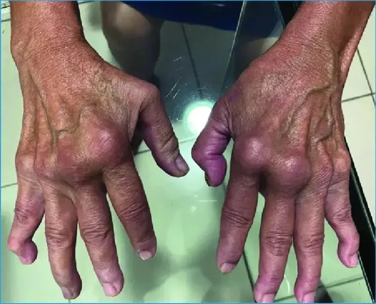 Close-up of hands showing joint deformities.