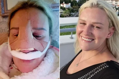 My nose was removed and reconstructed with my RIB in horror op after bizarre nosebleed when I jumped off boat in Turkey