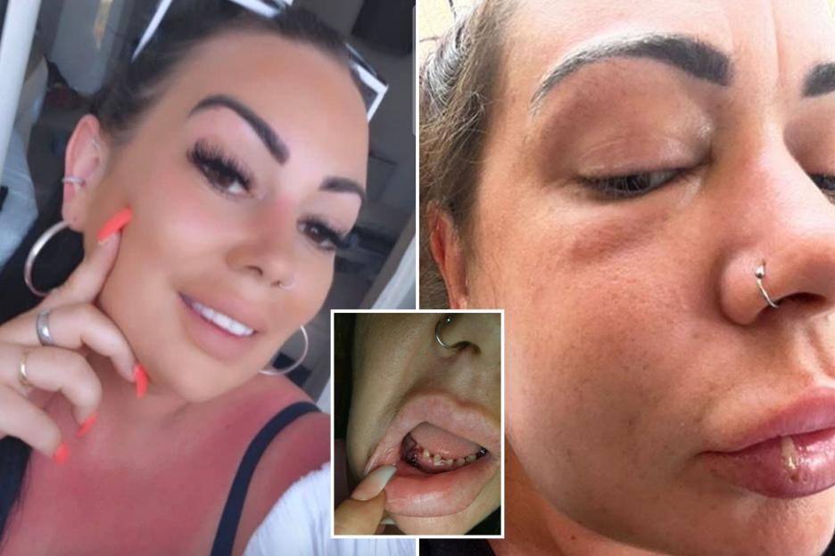 Mum's £18k Turkey Teeth Nightmare: Left Toothless with a Black Eye and Facial Infection—Now Struggling to Eat!