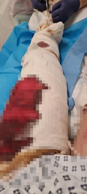 Patient's leg with severe burns, bandaged and showing bloodstains, undergoing treatment with a medical professional.
