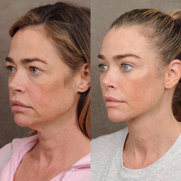 Denise Richards Flaunts Stunning Facelift Results, Fans Say She Looks Two Decades Younger!