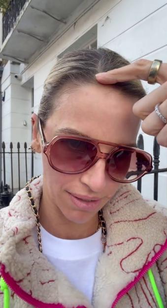 Vogue Williams wearing sunglasses and a fleece jacket, pointing at her hairline.