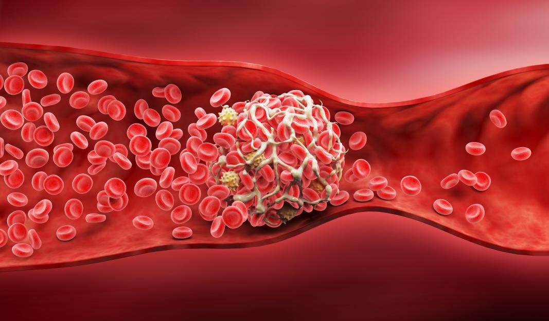 Illustration of a blood clot within an artery or vein, obstructing blood flow.