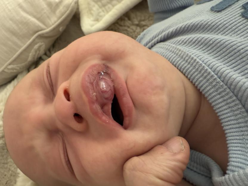 I thought white lump on newborns gum was a tooth but it was rare tumour with only 500 cases WORLDWIDE