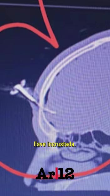 X-ray showing a key embedded in a skull.