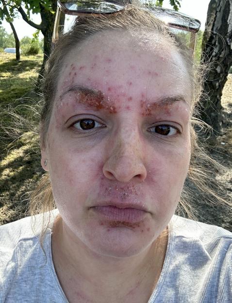 A woman with redness and scabbing on her face, particularly around her eyes and mouth, due to topical steroid withdrawal.