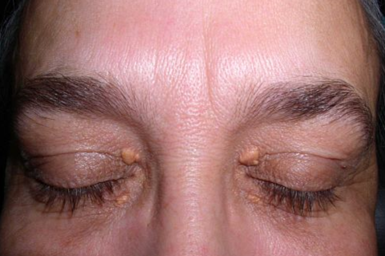 Close-up of a person's eyes with xanthelasma on the eyelids.