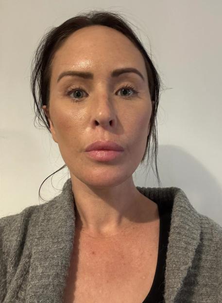 I Spent £10k and Faced a 19-Hour Flight for a Turkey Facelift – But Online Trolls Claim I Look Older!