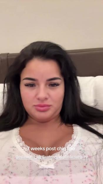 Love Island's Andrada Pop Reveals Stunning Chin Liposuction Transformation with Before and After Photos!