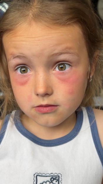 Close-up of a young girl's face with red skin irritation around her eyes and on her cheeks.