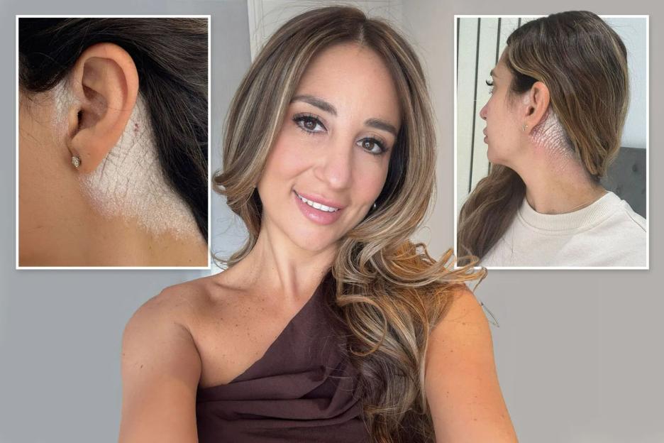 'After Facing Cruel Trolls for My Shedding Skin, This £12 Shampoo Became My Ultimate Skin-Saving Hero!'