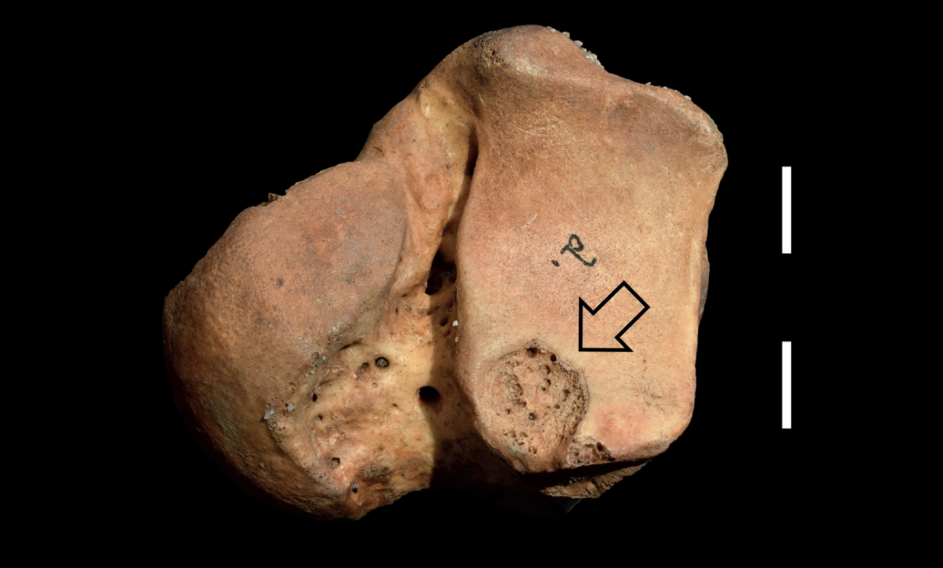 Bone showing evidence of trauma with an arrow pointing to a depression.