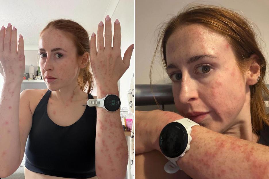 31-Year-Old Woman Wakes Up with Over 100 Bed Bug Bites in Blood-Stained Travelodge Room