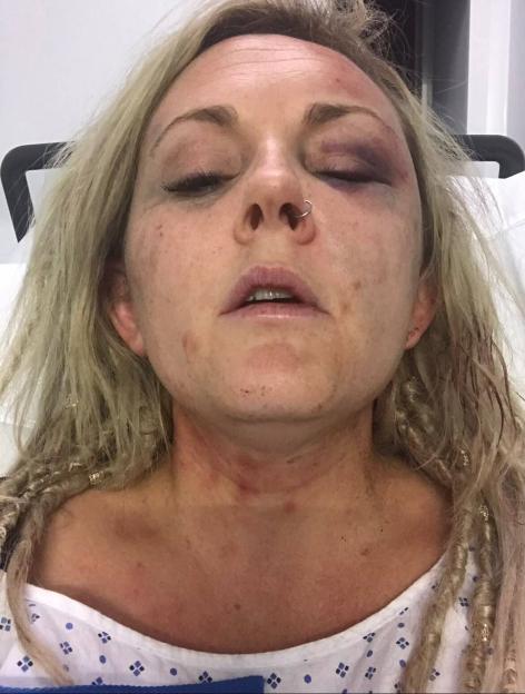 A woman with multiple bruises around her eyes and on her face.