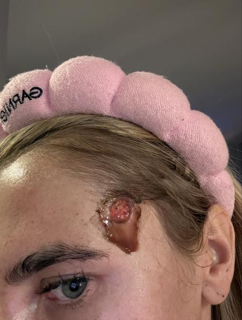 A person's eye and temple area, revealing a circular red lesion on the temple area of the head, and a pink headband.