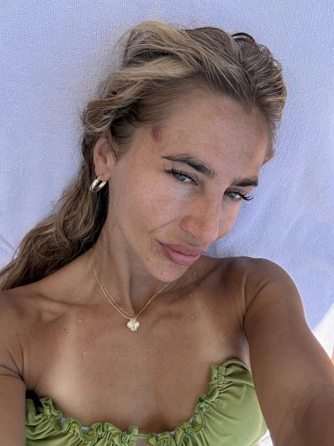Close-up of a woman's face and upper chest with a red patch, possibly a skin lesion, on her forehead.