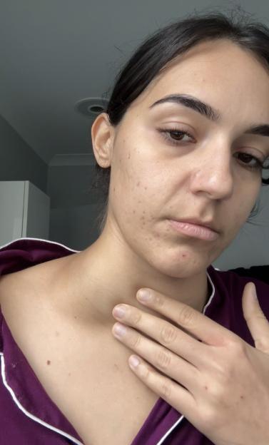 ¿I was itching myself to death every night ¿ doctors thought I needed moisturiser, but it turned out to be far more sinister¿