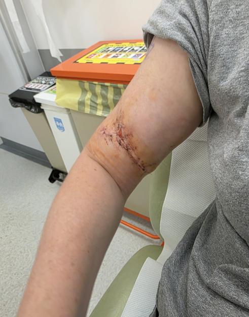 'I adopted a dog from Facebook - weeks later he attacked me and I needed surgery'