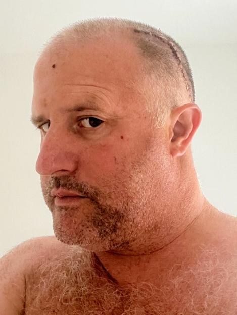 A man with a shaved head shows a prominent surgical scar running along the top of his scalp.