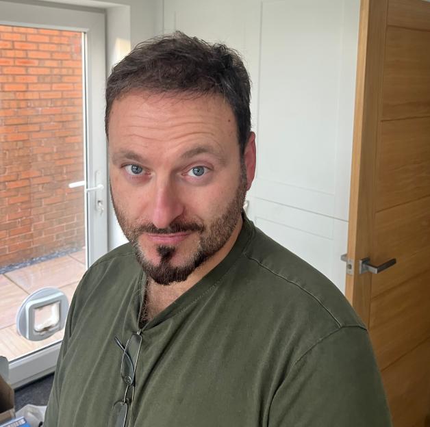 A man with a beard and dark hair looks directly at the camera, showing the results of his first hair transplant.