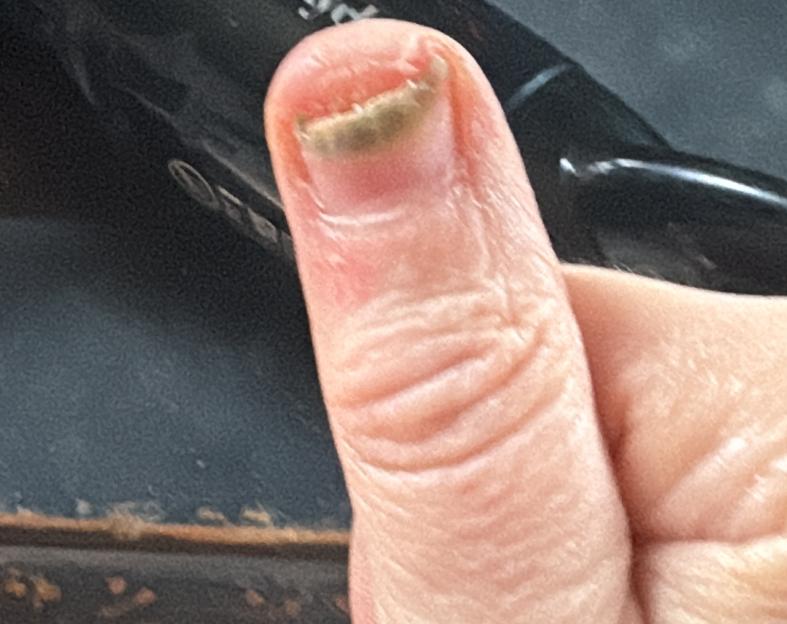 A close-up of a finger with a green, peeling, and blistered fingernail.
