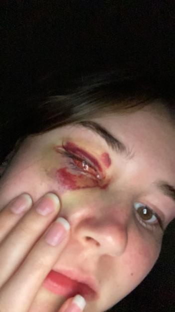 I lost my eye due to a rare cancer  I felt sick to my stomach when I looked in the mirror after surgery