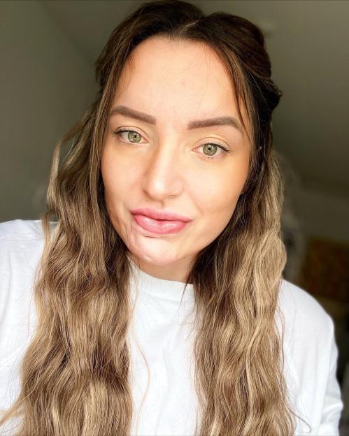 A headshot of Ashleigh Charlesworth, with long wavy hair and noticeable scarring on her face and around her mouth, looking at the camera.