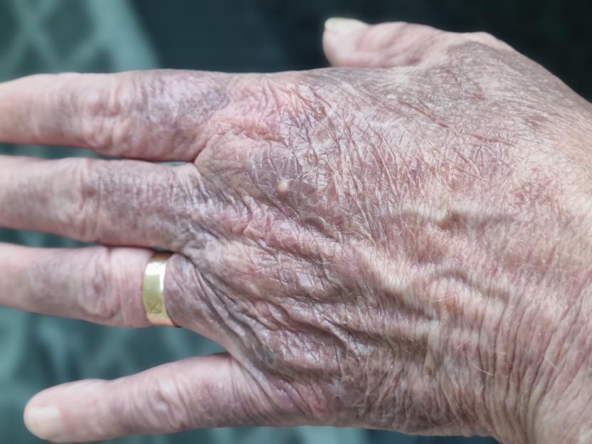 Close-up of a person's hand with dry, reddish-purple skin and a gold ring on one finger.