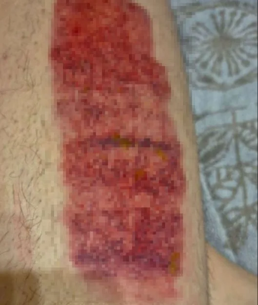 Photo showing a large, rectangular patch of raw, red, and inflamed skin.