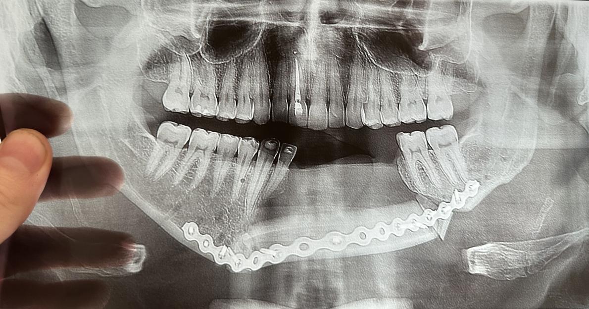 X-ray of Andre Gayoso's jaw with a metal reconstruction plate along the lower jaw and missing teeth.