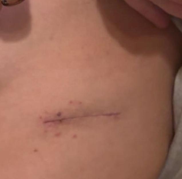 Woman diagnosed with lung cancer aged 21 after doctors turned her away 8 times