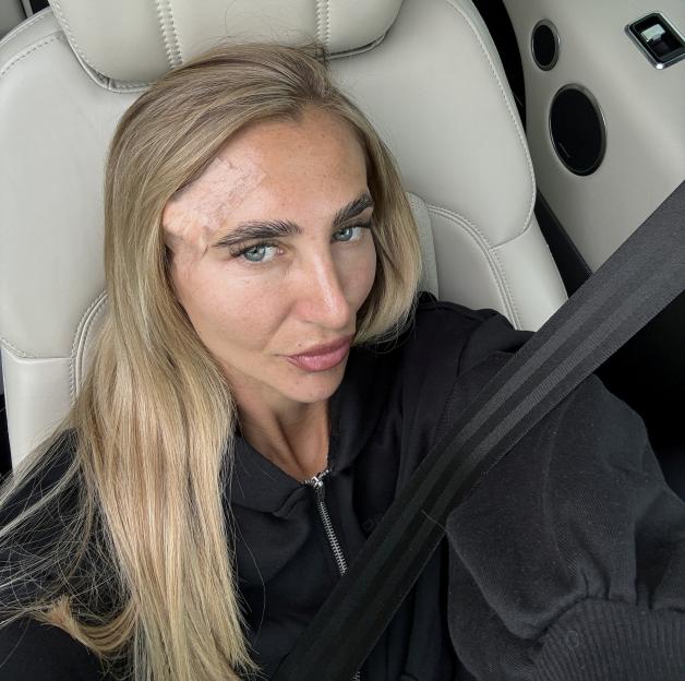 Beth Brown with a bandage on her forehead, advocating for skin cancer awareness.