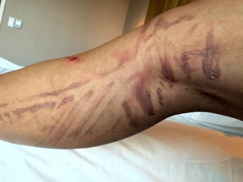 Nicole Scherzinger shows off painful scars after horrific injury with her leg looking bloodied and blistered.