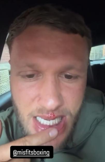'UK's Toughest Guy, Big Stacks, Displays Busted Lip and Crooked Teeth After Rival's Punch in Misfits Brawl'