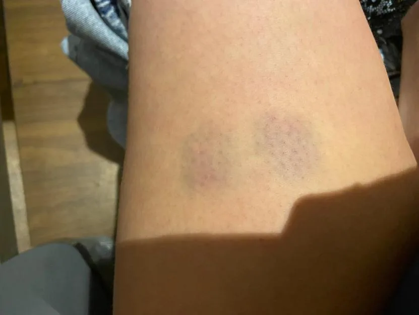 'Monster boyfriend left me traumatised, covered in bite marks and £12k in debt'