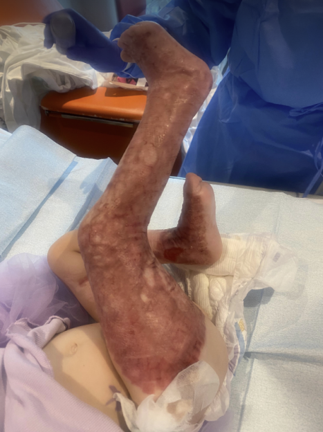 A baby's leg and foot, showing extensive burn marks and scarring, with a diaper around the waist.